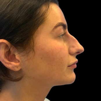 ultrasonic-rhinoplasty-before